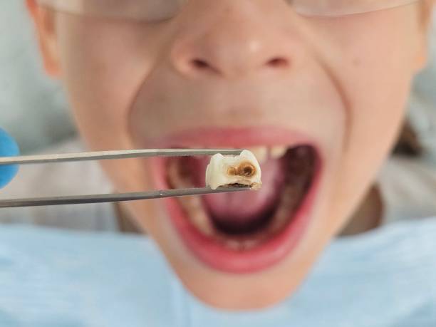 Best Emergency Tooth Extraction  in Parkwood, CA